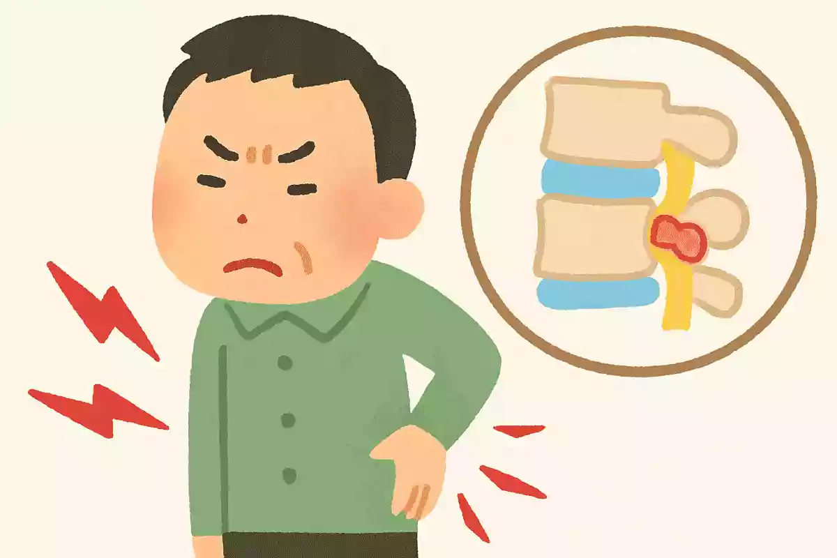 ドイツでぎっくり腰はなんと呼ばれている?