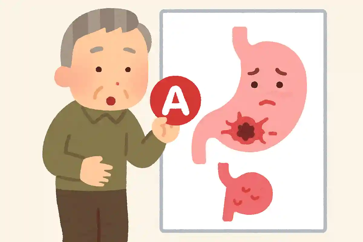 胃潰瘍になるリスクが高い血液型は何でしょうか？