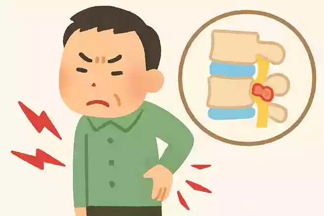 ドイツでぎっくり腰はなんと呼ばれている？